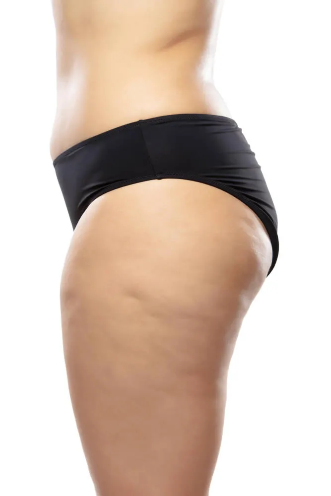woman-with-cellulite-coolscupting